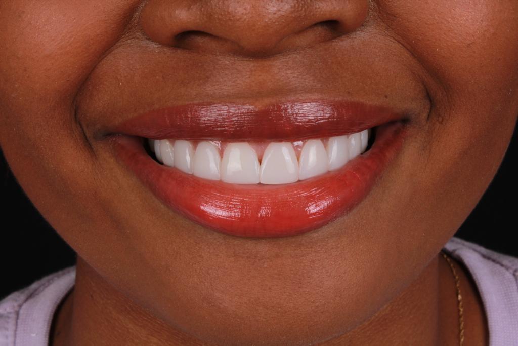 Después diseño dental